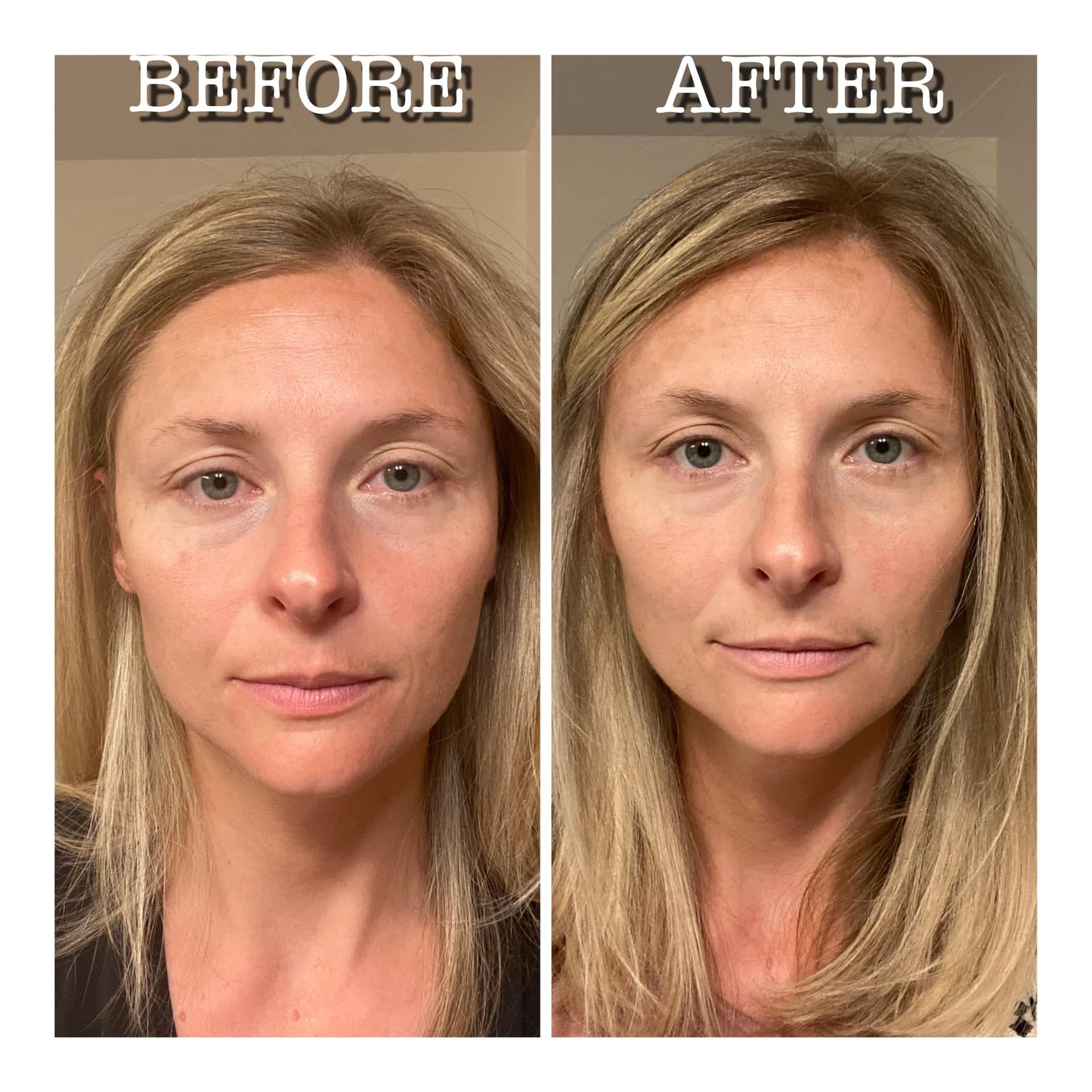 Allison's before and after results from using marine collagen